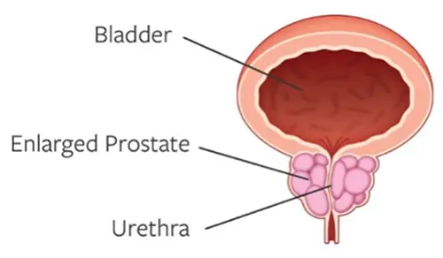 Enlarged Prostate Enlarged Prostate